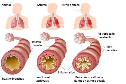 Asthma