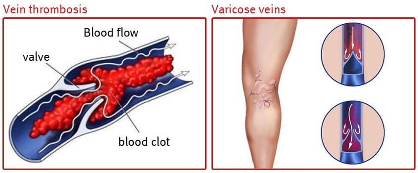 Venous stasis