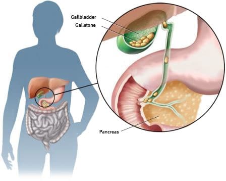 Disorders of gallbladder