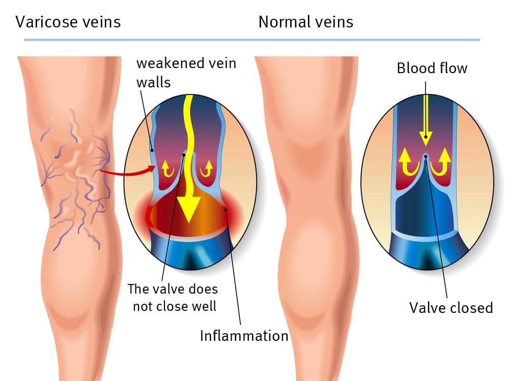 Varicose veins