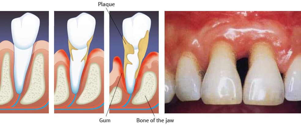 Periodontitis