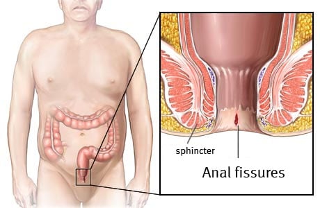 Anal fissures