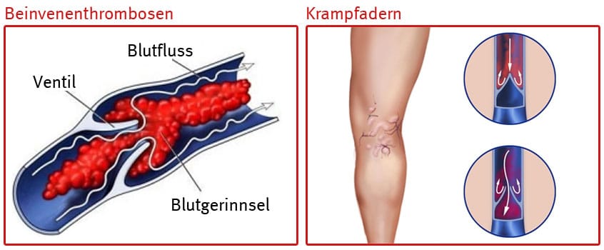 Beinvenenthrombosen-und-Krampfadern