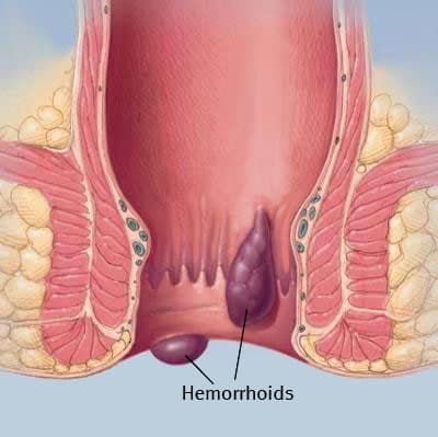 Hemorrhoids