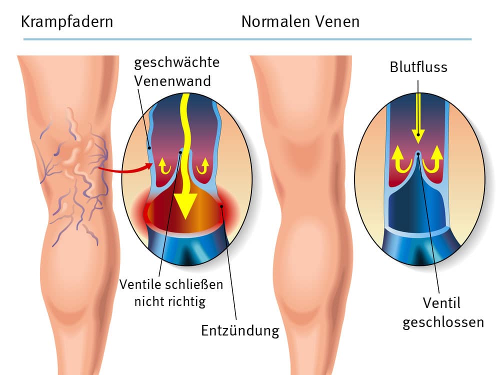 Krampfadern_1600px